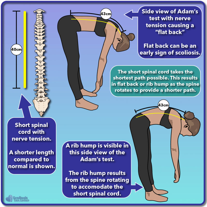 Results by Rib Hump Improvement - Scoliosis Care Centers