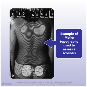 Example of scoliosis screening using Moire topography