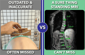 Improved and accurate scoliosis screening using MRI