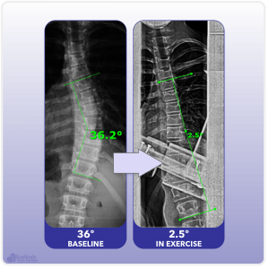 X-ray showing curve reduction during scoliosis specific exercise