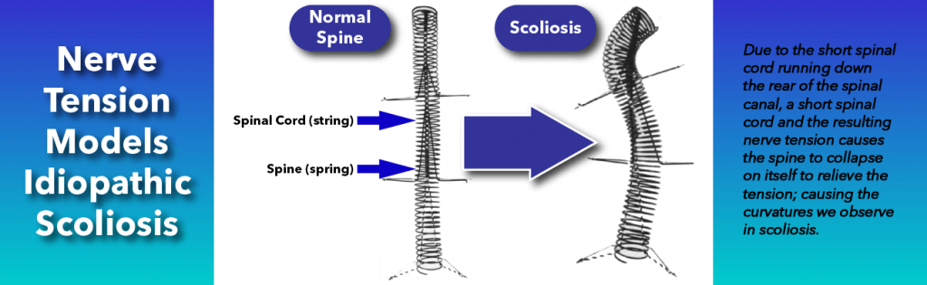 Nerve tension model for idiopathic scoliosis