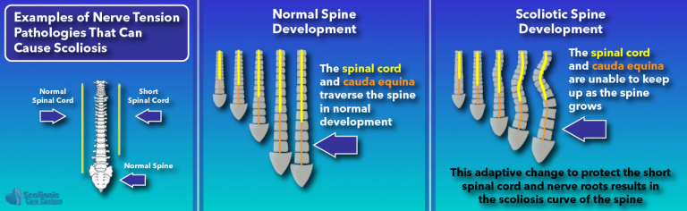 Frequently Asked Questions About Scoliosis (FAQ)