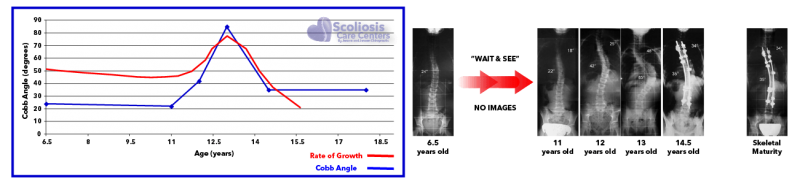 Worried Your Child’s Scoliosis Might Be Growing Worse?  ScoliSnap Can Help.