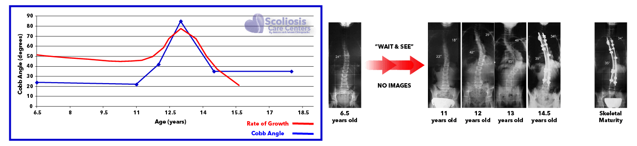 Scoliosis progression and rate of growth during puberty