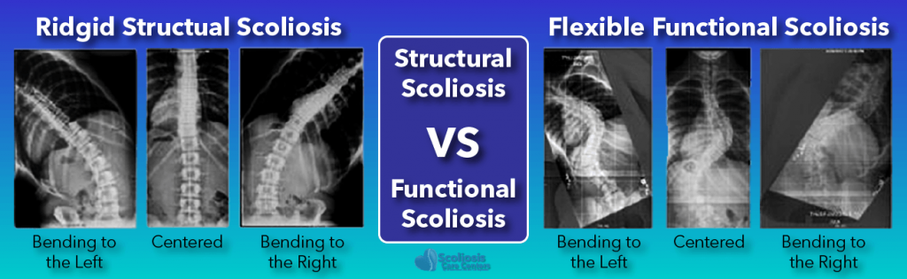 what-is-scoliosis-scoliosis-defined-its-causes-scoliosis-care-centers