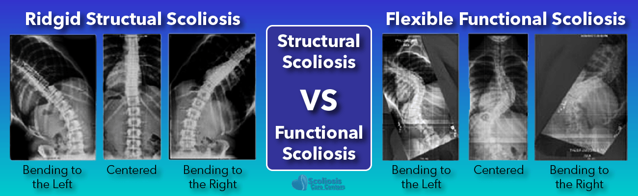 What Is Scoliosis? Scoliosis Defined & Its Causes - Scoliosis Care Centers