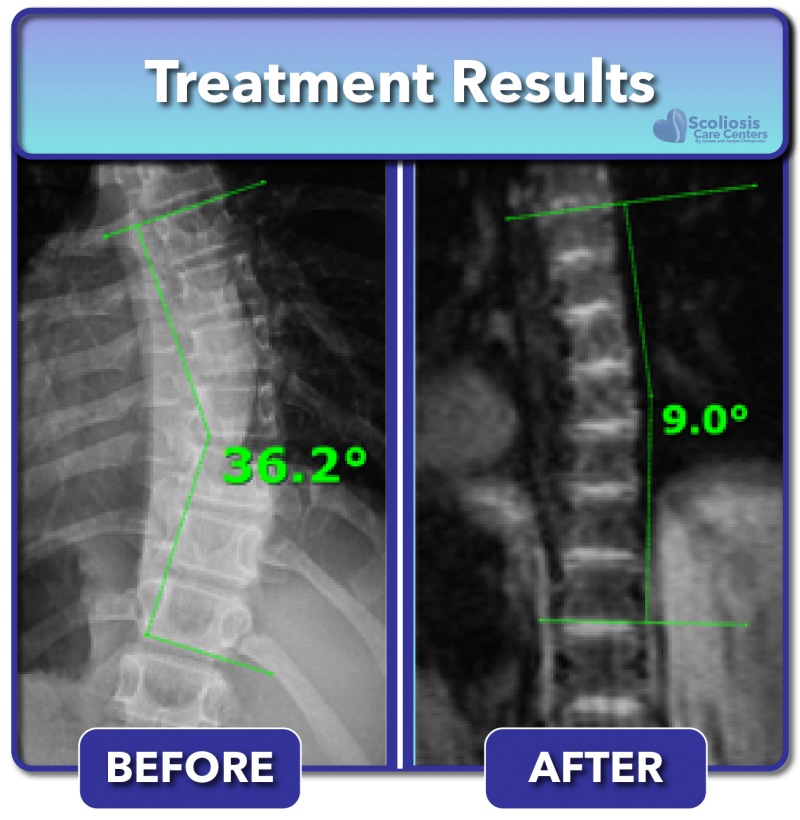 Scoliosis Before And After Treatment Results Scoliosis Care Centers