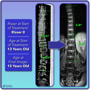Risser 0 scoliosis treatment results for 17.5 degree curve