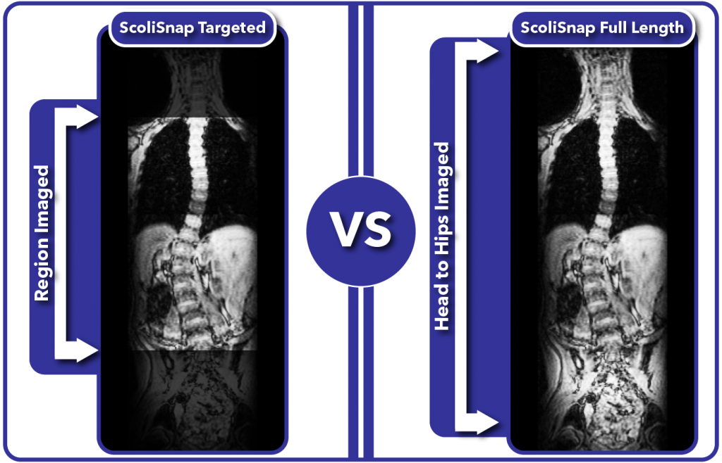 Comparison of targeted versus full length MRI monitoring of scoliosis