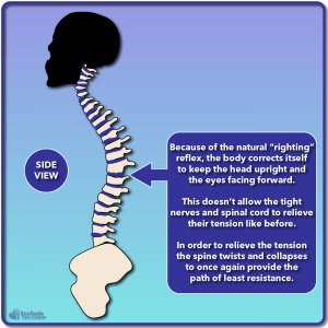 Side view illustration of nerve tension resulting in scoliosis posture rotation and collapse