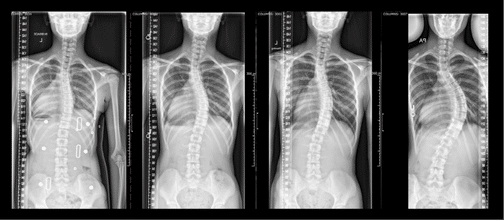 Progression of Starr's spinal curves over time before surgery.