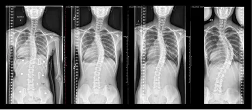 Progression of Starr's spinal curves over time before surgery.