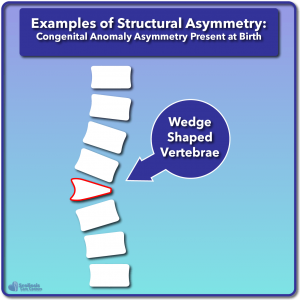 Example of congenital wedged vertebrae structural asymmetry