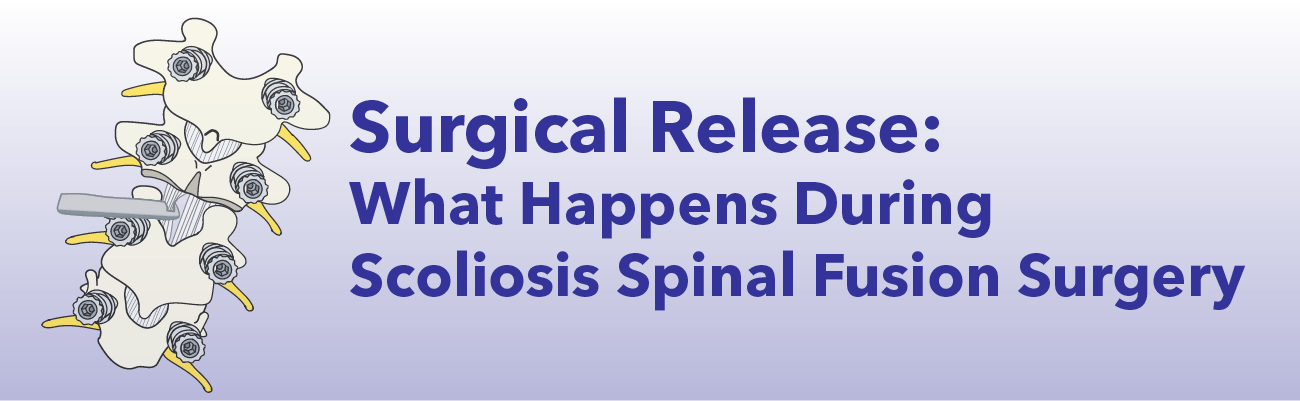 Surgical release during spinal fusion surgery banner