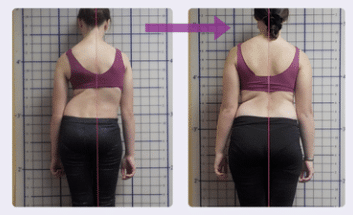 Posture transformation before and after scoliosis treatment