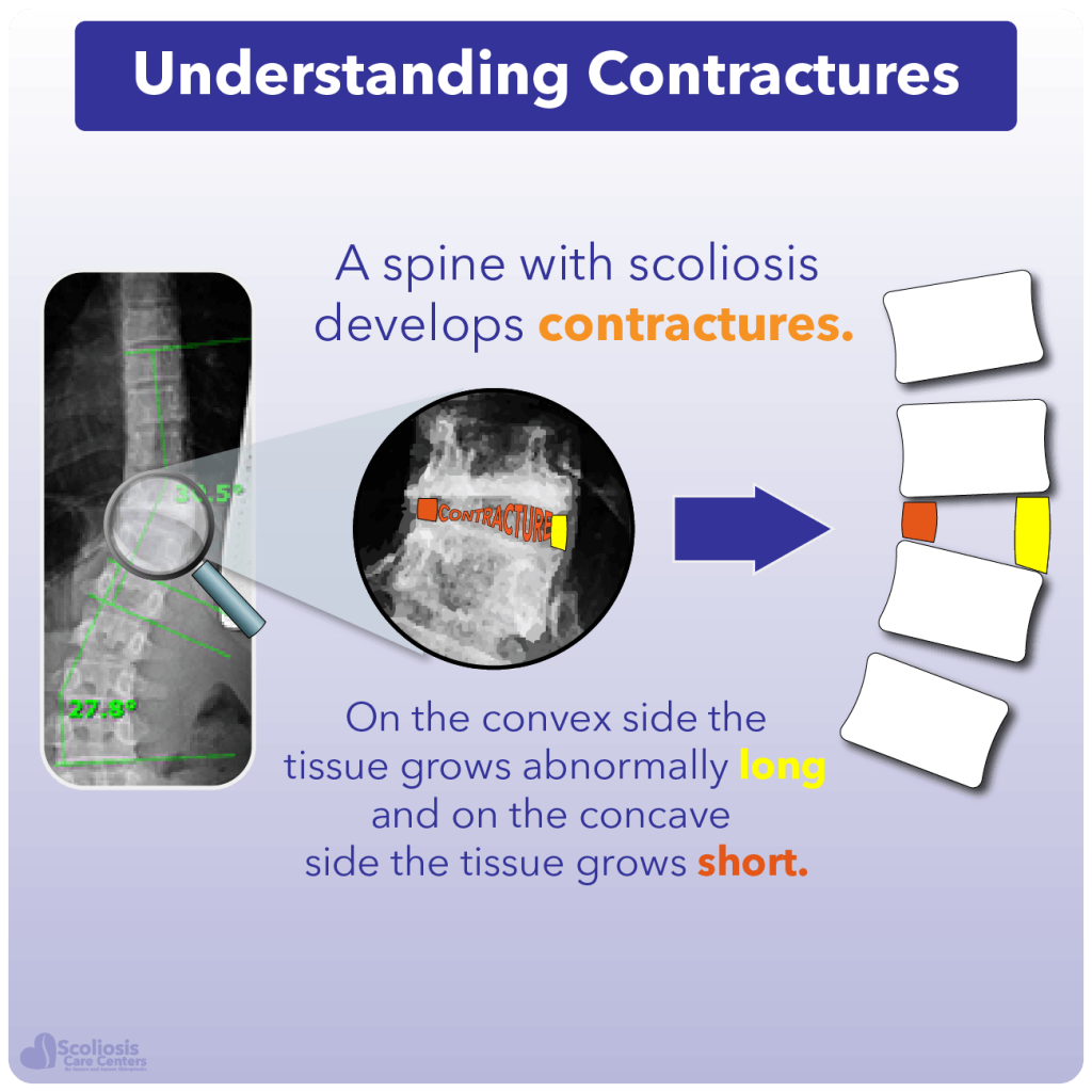 Explanation of what contractures are and example x-ray