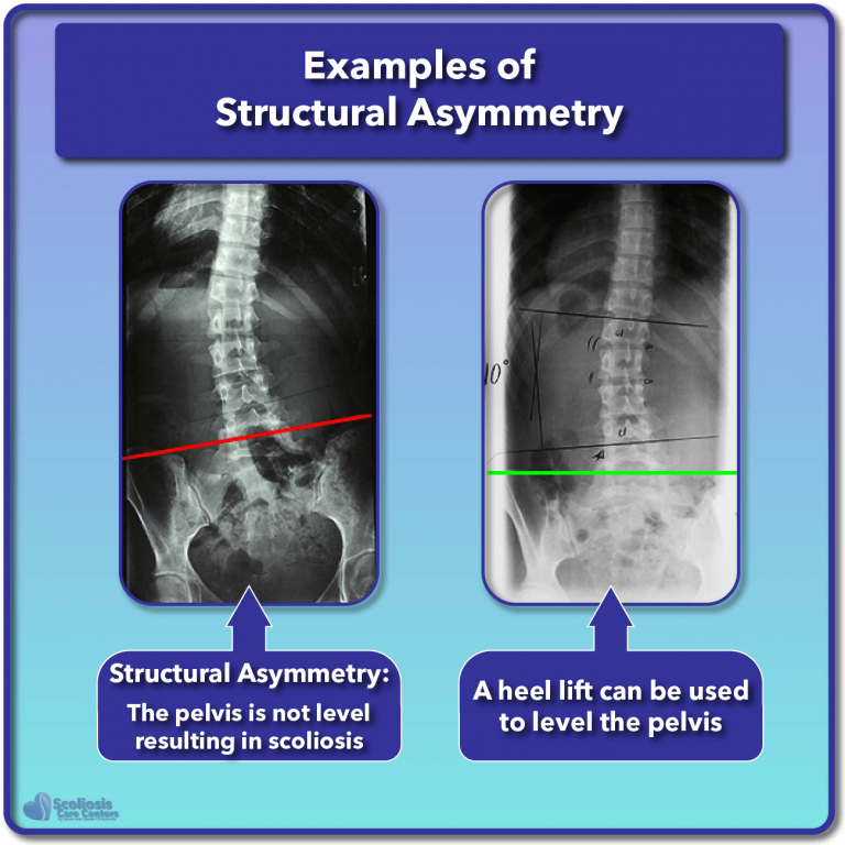 What is Scoliosis? Scoliosis Defined & Its Causes Scoliosis Care Centers