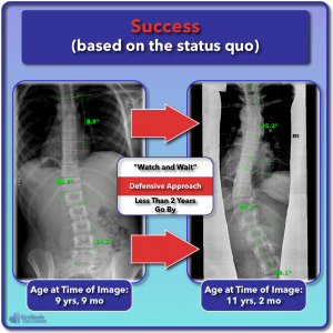 Example of scoliosis curve worsening progressing with "watch and wait" observation
