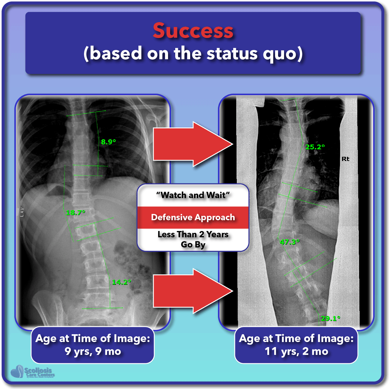 Scoliosis Treatment for Children and Teens Scoliosis Care Centers